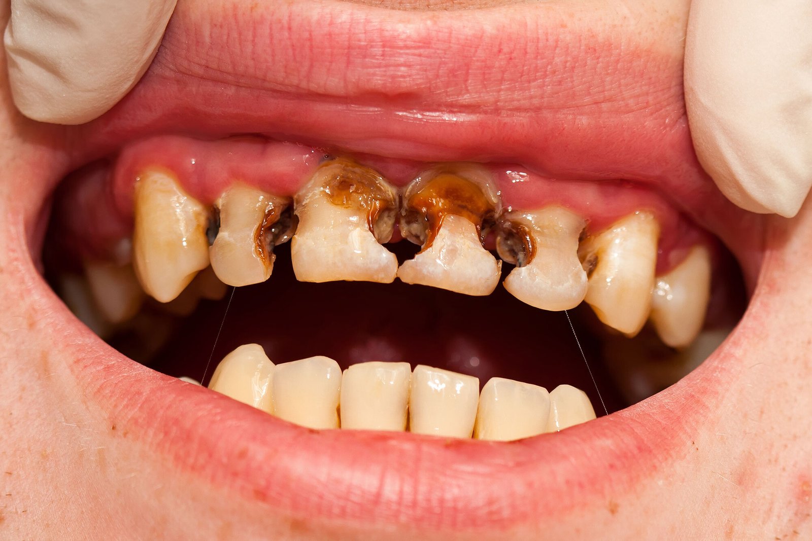 راه جلوگیری از پوسیدگی دندان
